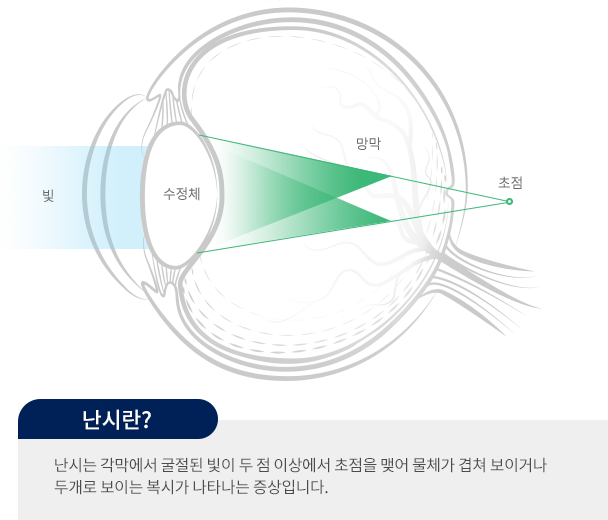 난시란? 난시는 각막에서 굴절된 빛이 두 점 이상에서 초점을 맺어 물체가 겹쳐 보이거나 두개로 보이는 복시가 나타나는 증상입니다.