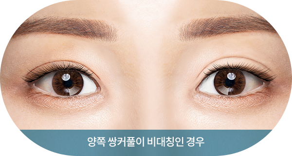 양쪽 쌍커풀이 비대칭인 경우