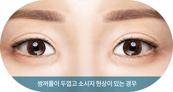 쌍꺼풀이 두껍고 소시지 현상이 있는 경우