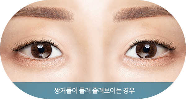 쌍커풀이 풀려 졸려보이는 경우