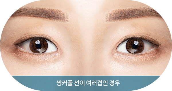 쌍커풀 선이 여러겹인 경우