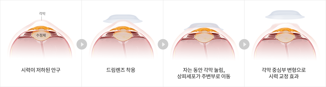 드림렌즈 시력 교정 과정