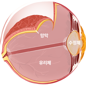 망막박리