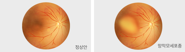 망막모세포종