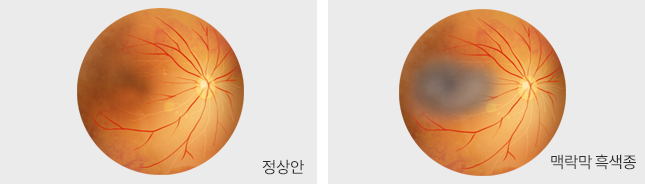 맥락막 흑색종